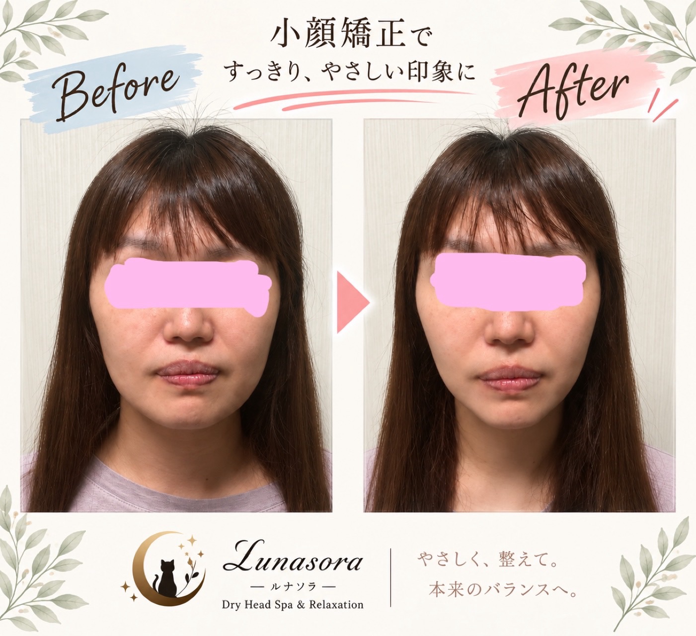 小顔矯正 Before/After|フェイスラインをすっきり整えて、やさしい印象に